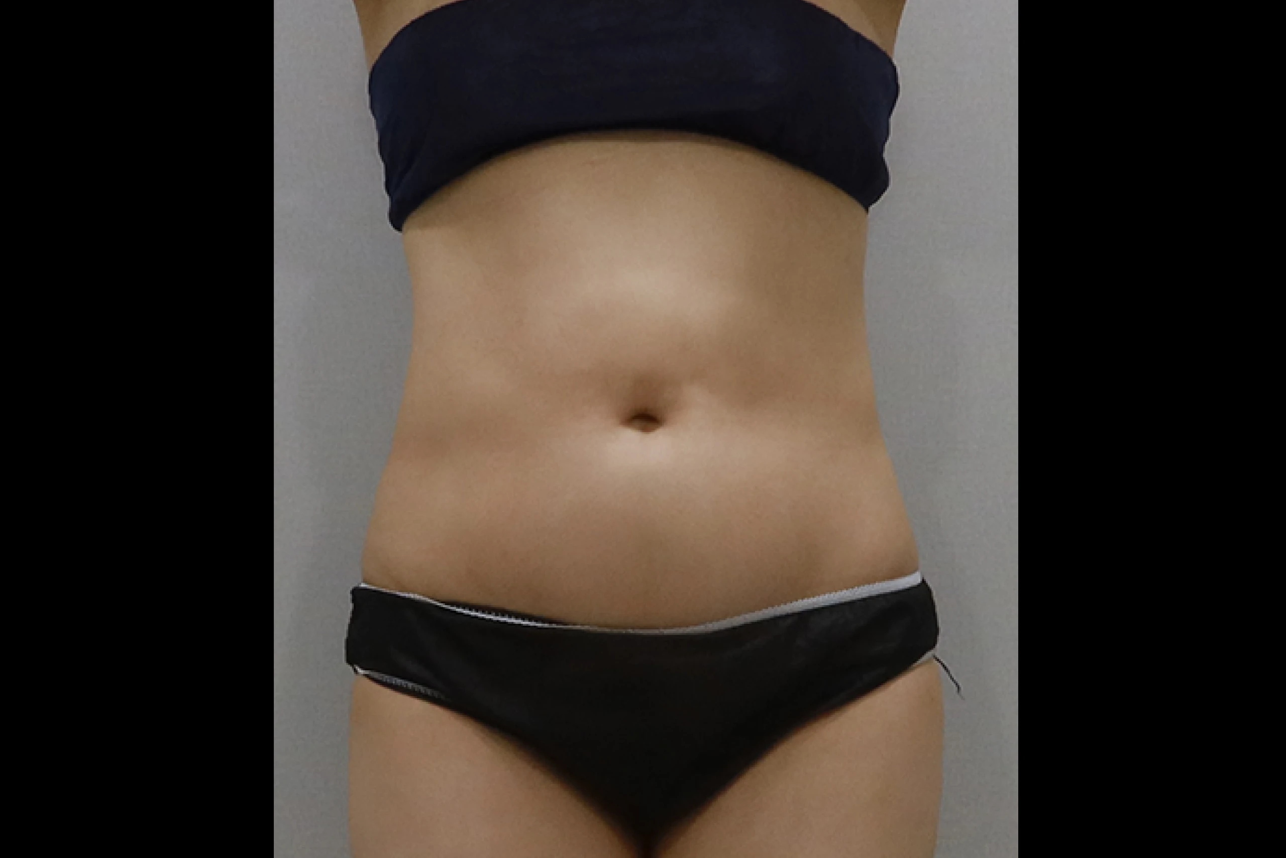 Dr.Eraser Upper body before lipolysis front view 2