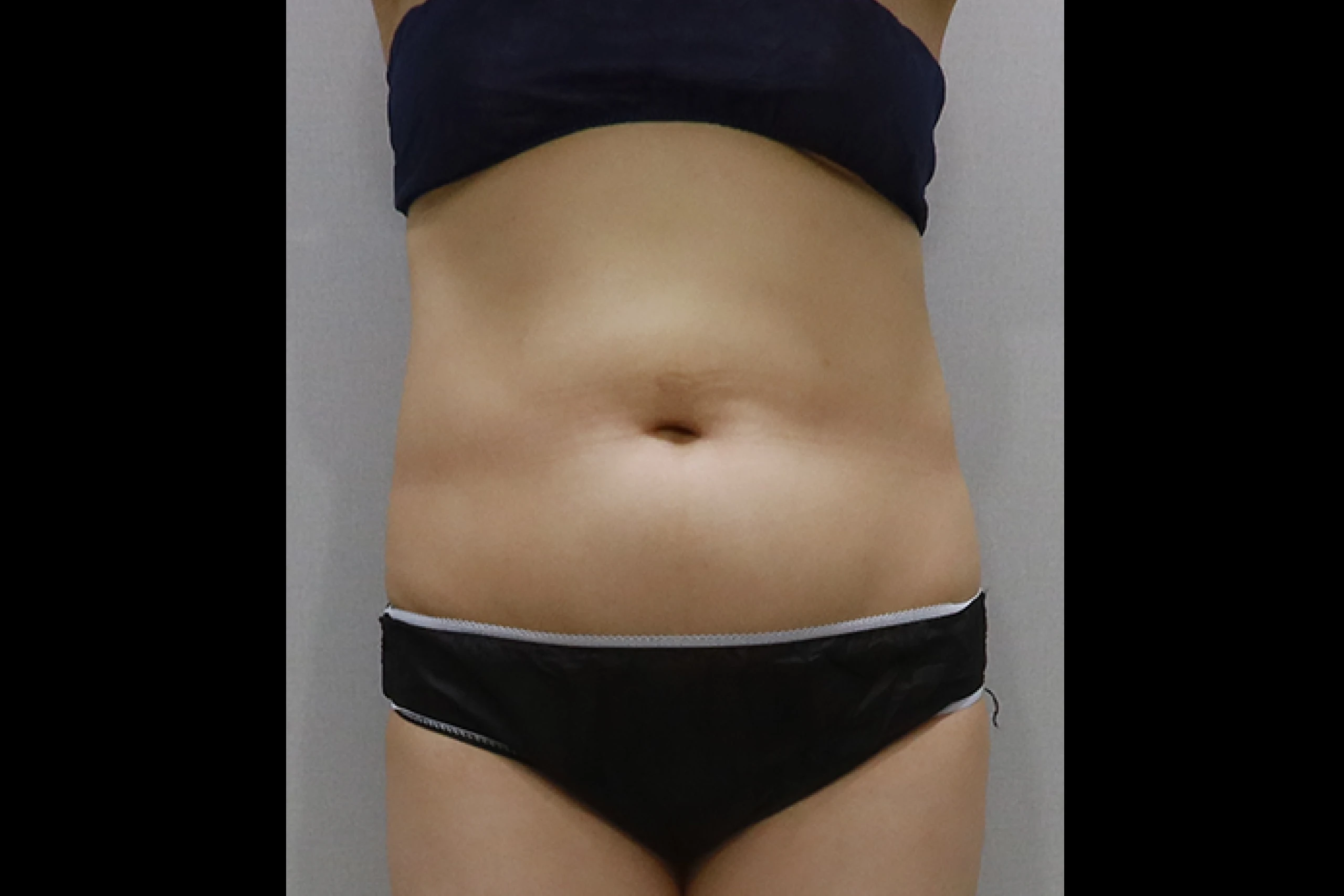 Dr.Eraser Front view after upper body lipolysis 2