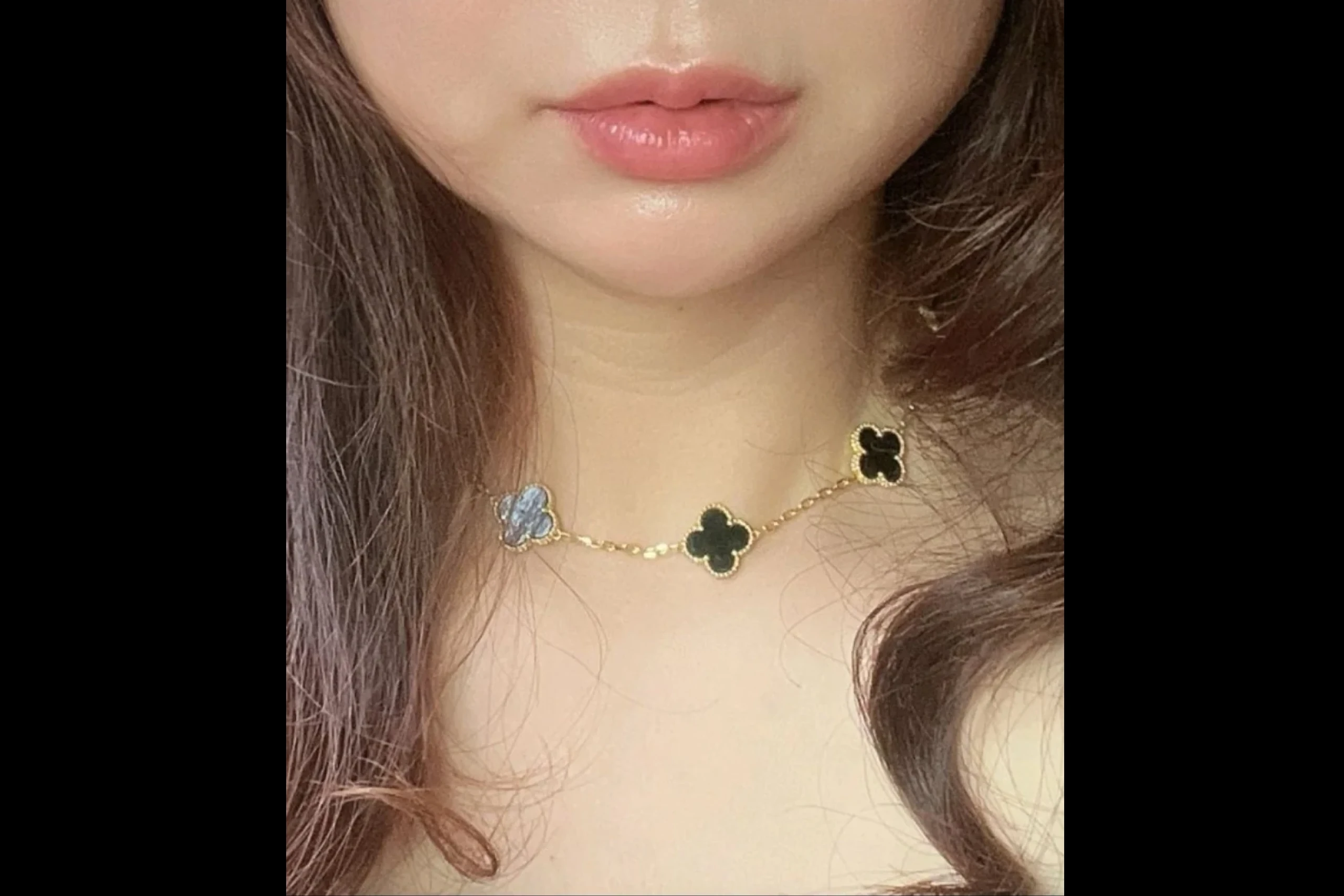 Dr.Eraser before lip filler