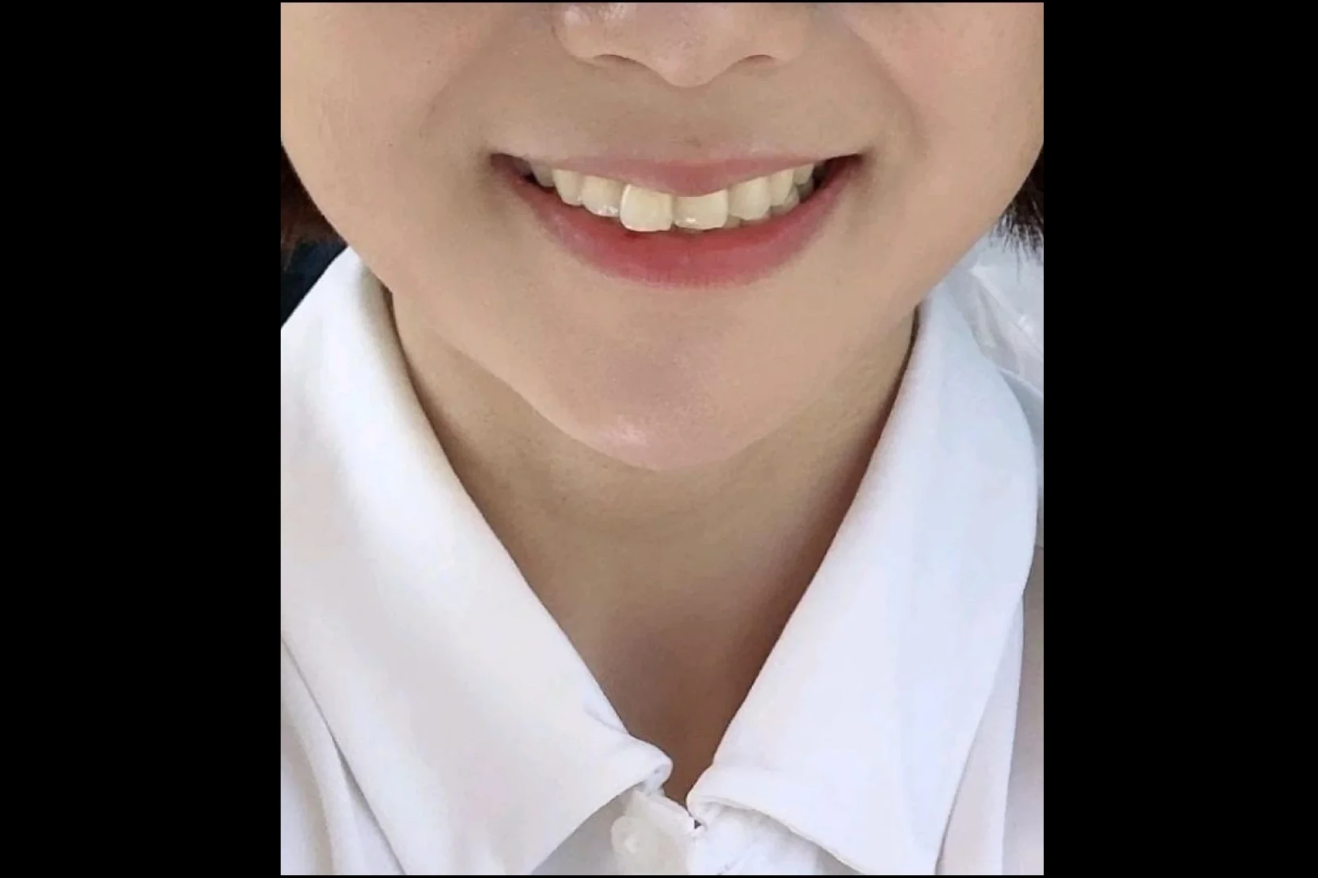 Dr.Eraser lip filler post-volume