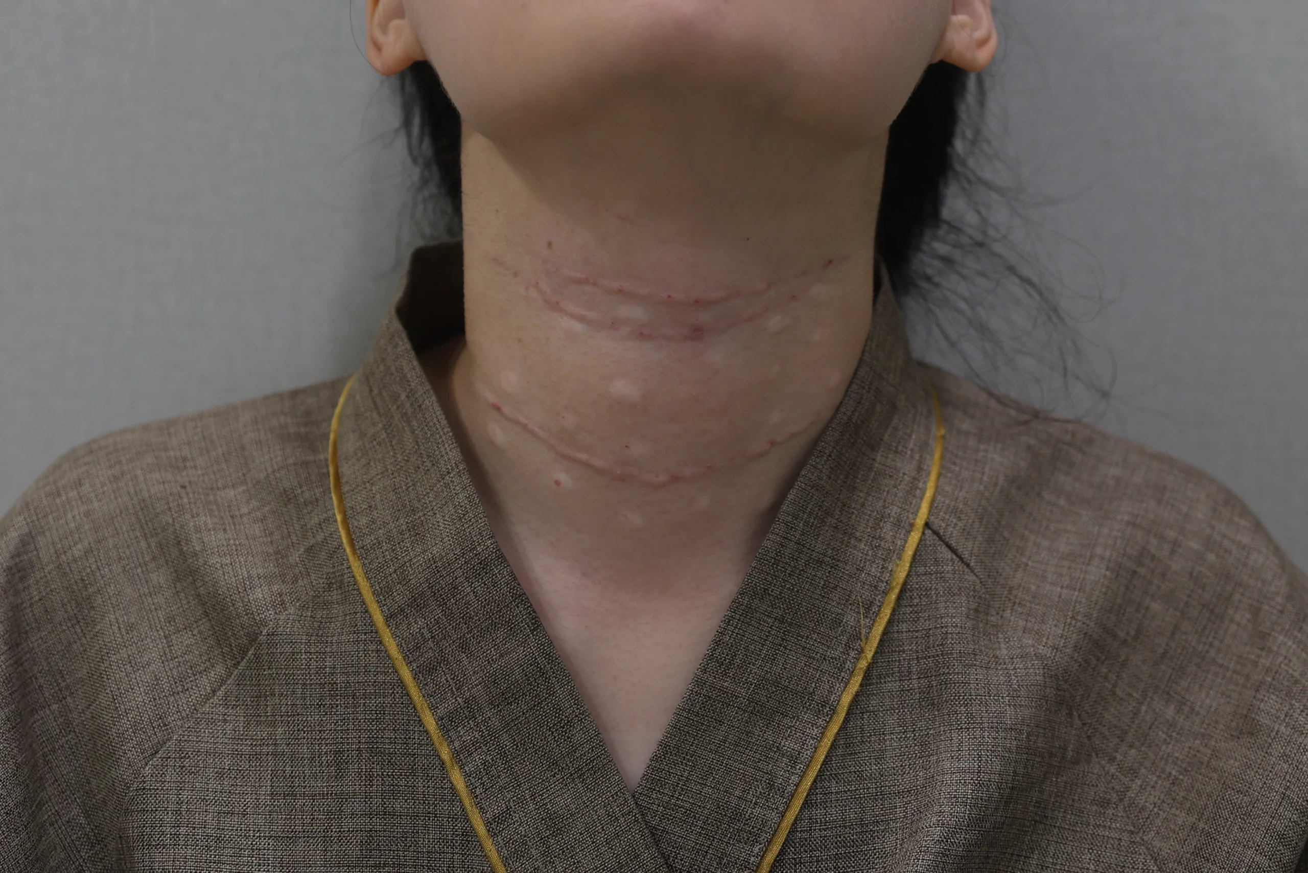 Neclisset Neck Wrinkle Eraser Add pre-procedure photos to your case