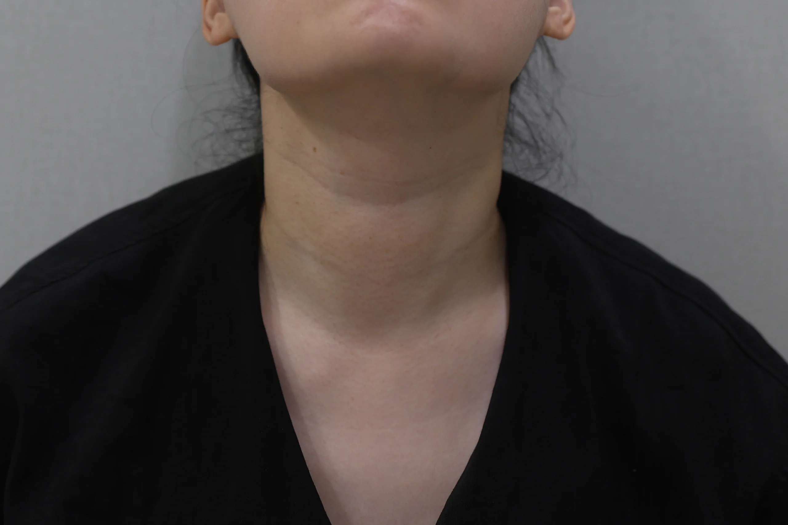 Add a post-procedure photo of your Necklisset Neck Wrinkle Eraser case