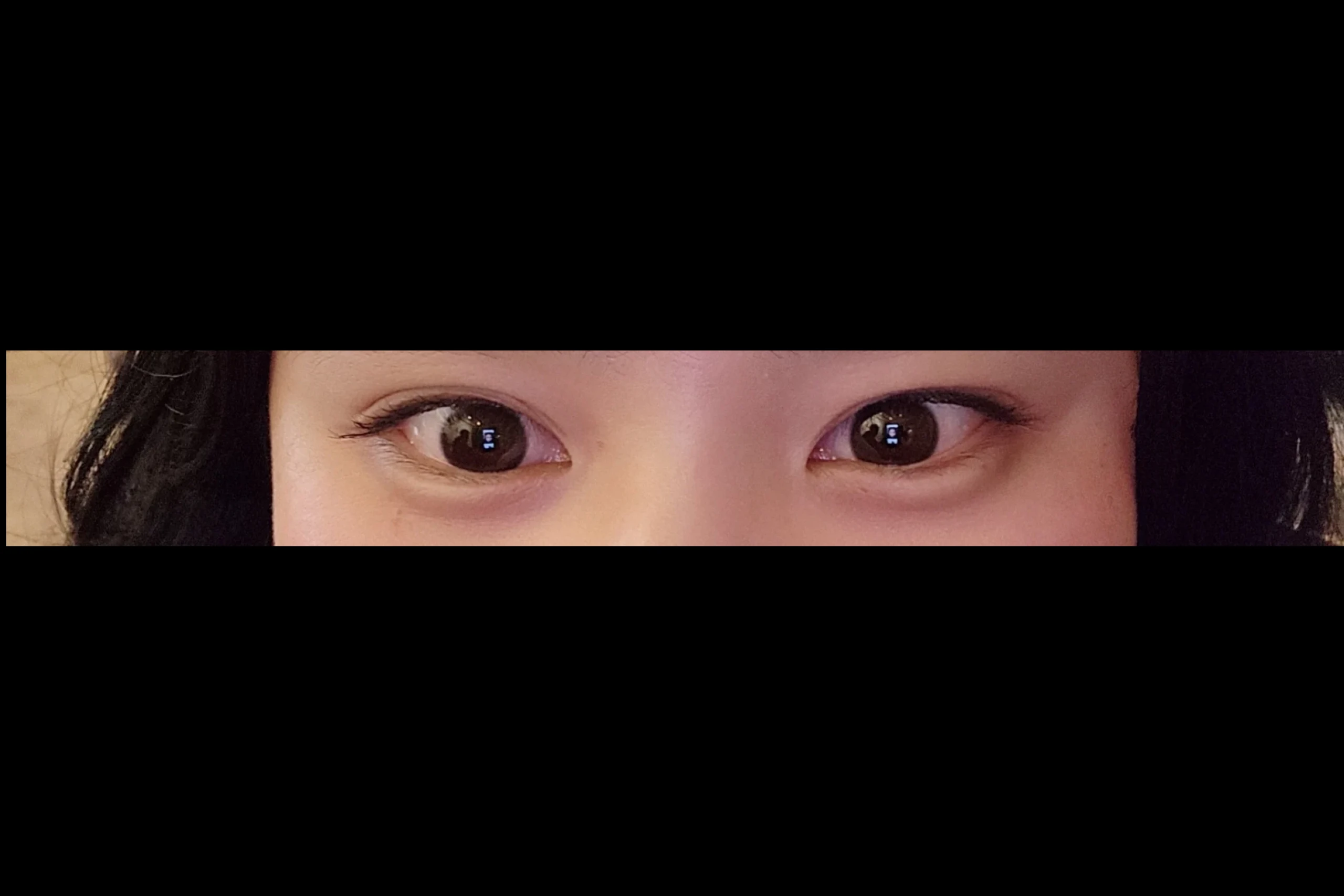 Dr.Erasers under eyes before filler