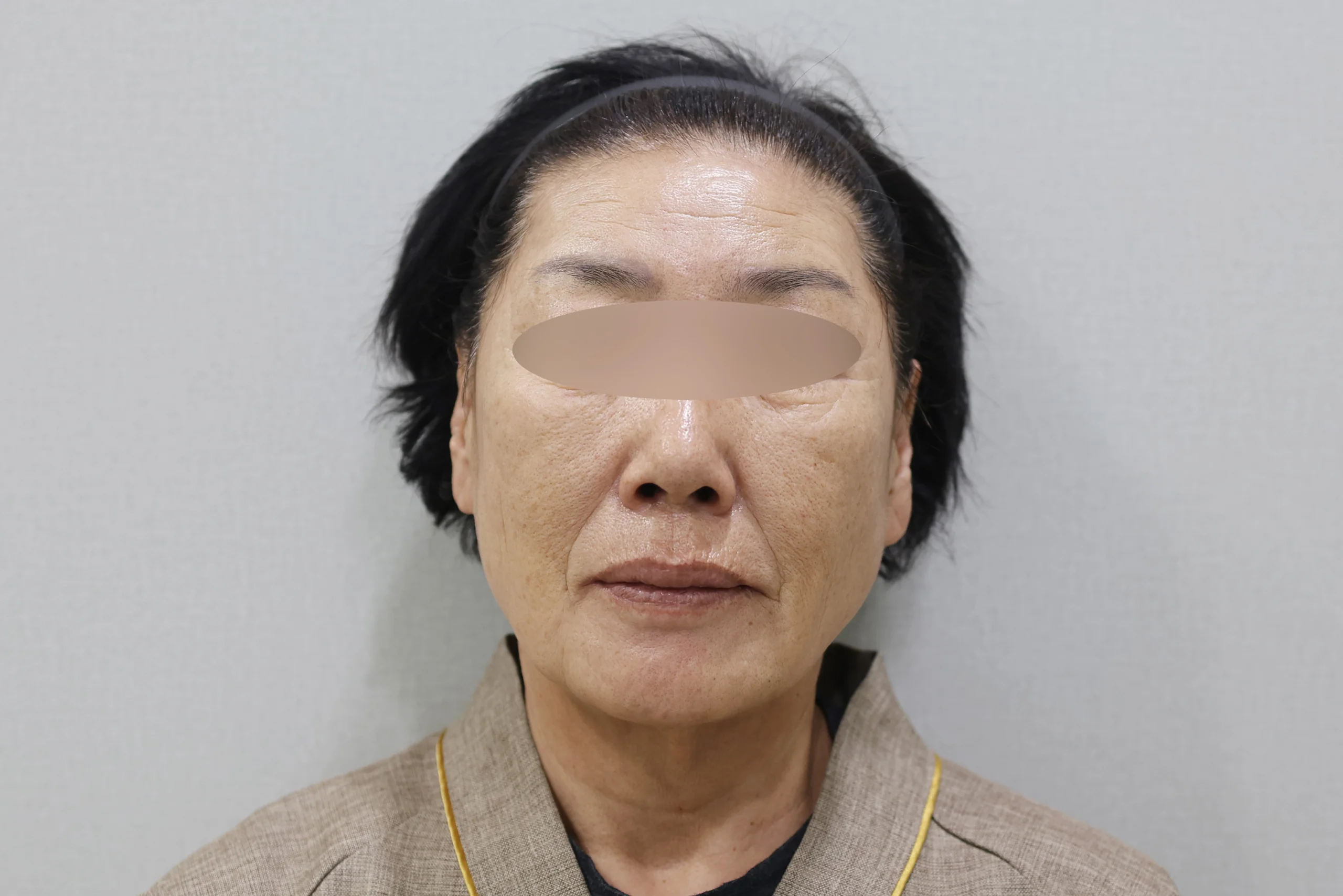 Frontal view 2 after XERF treatment