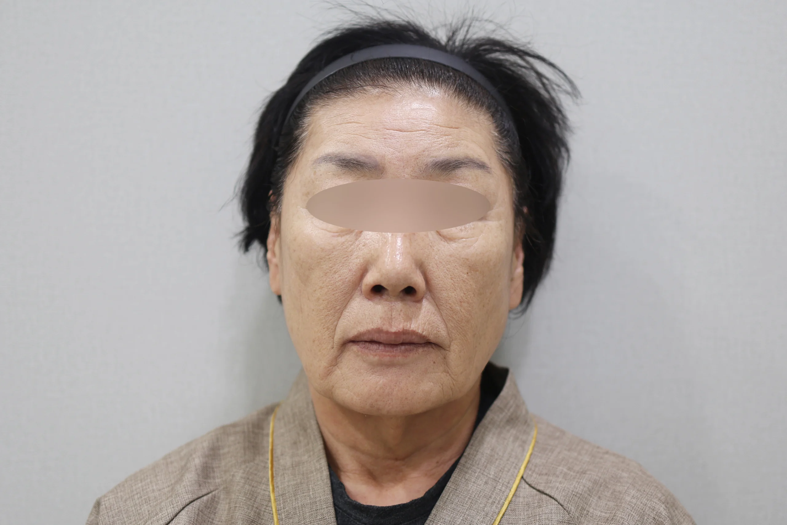 Frontal view 2 before XERF treatment