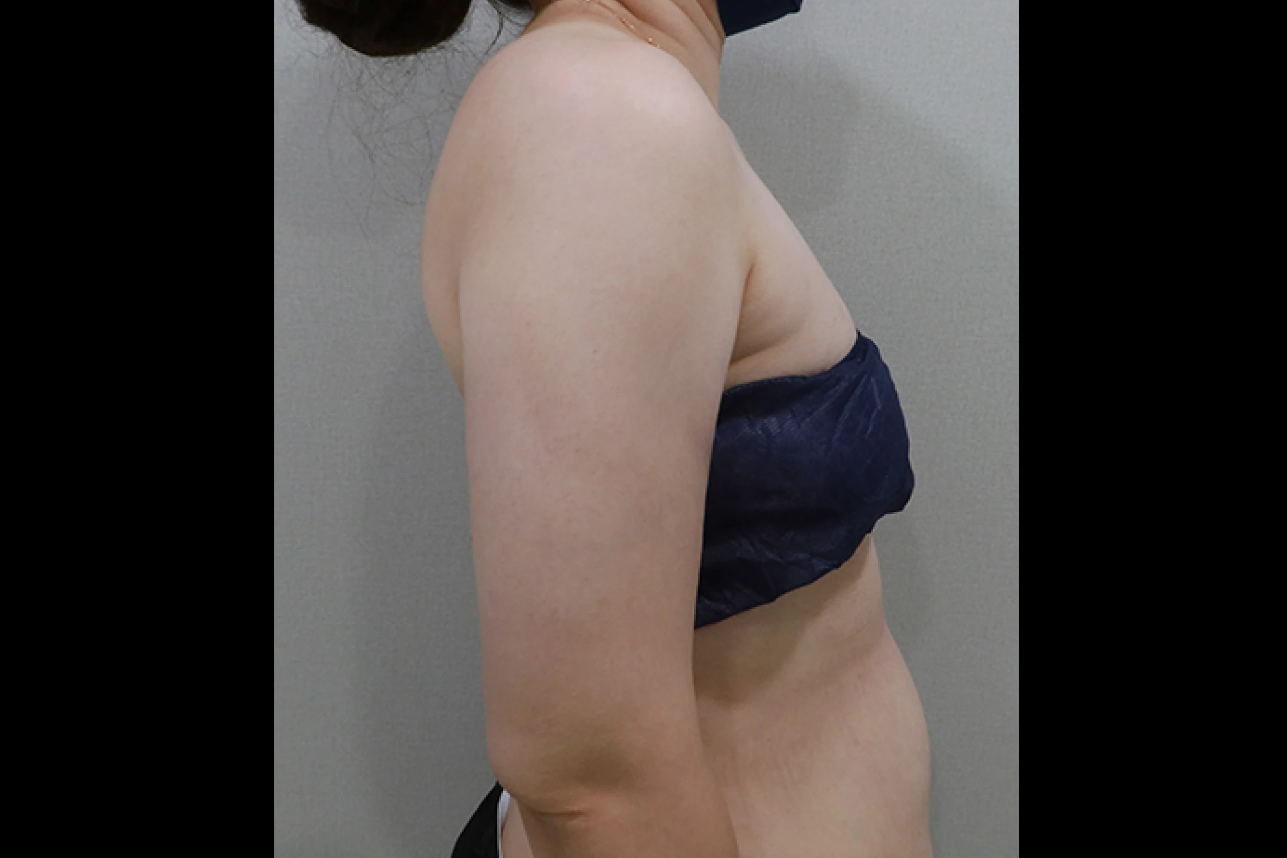 Side view after body titanium laser treatment 03
