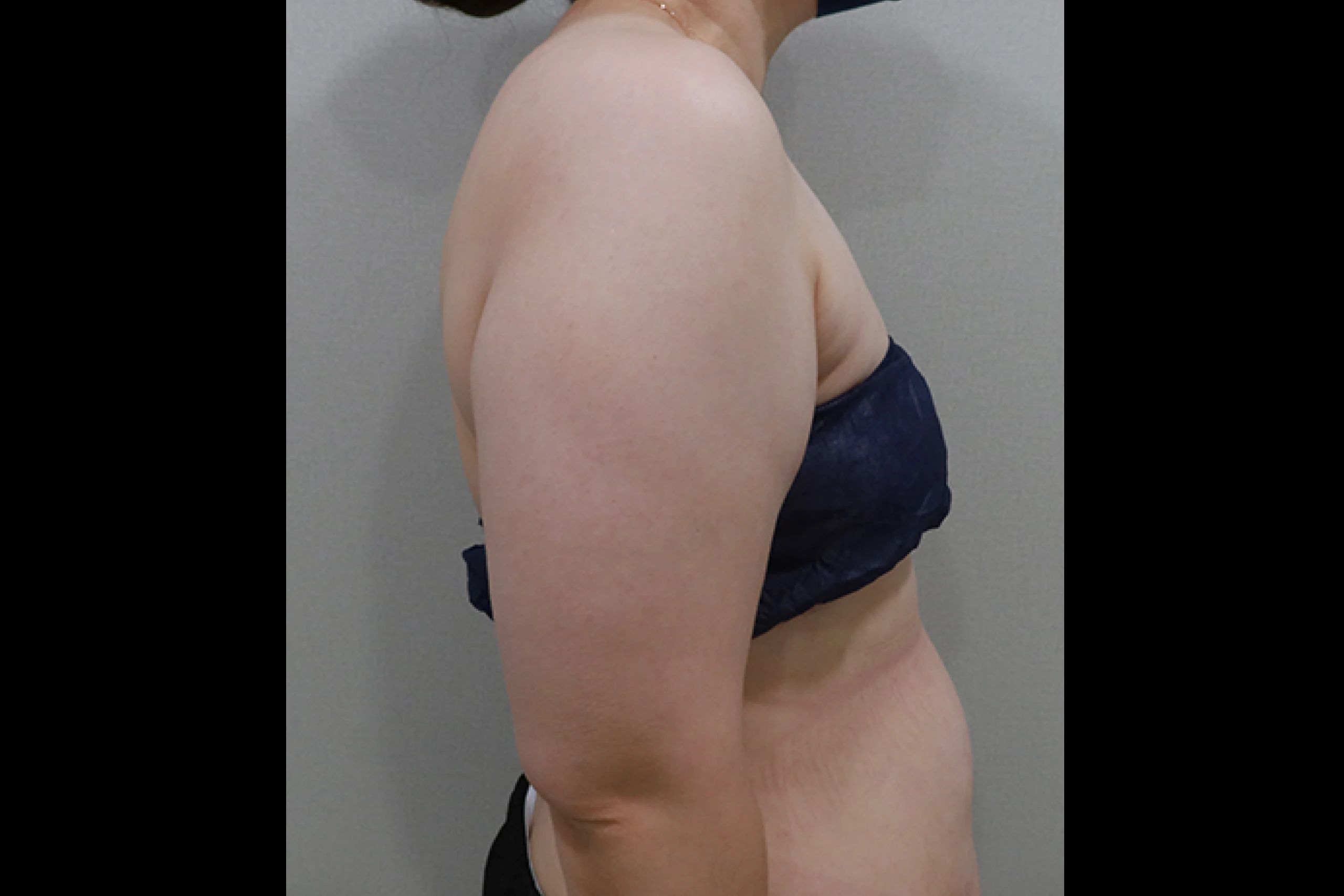 Side view before body titanium laser treatment 03