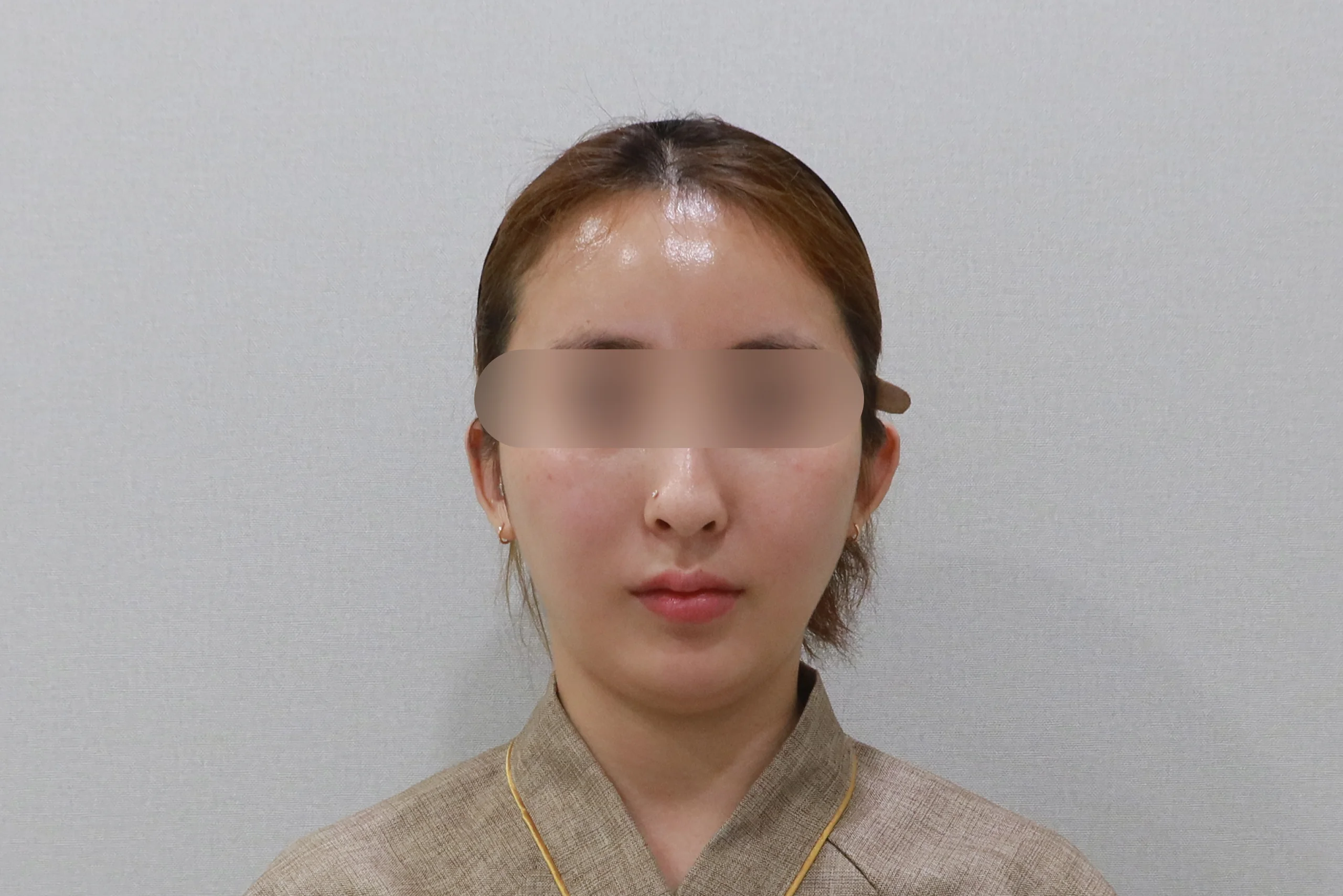 Frontal view after facial eraser injection 3