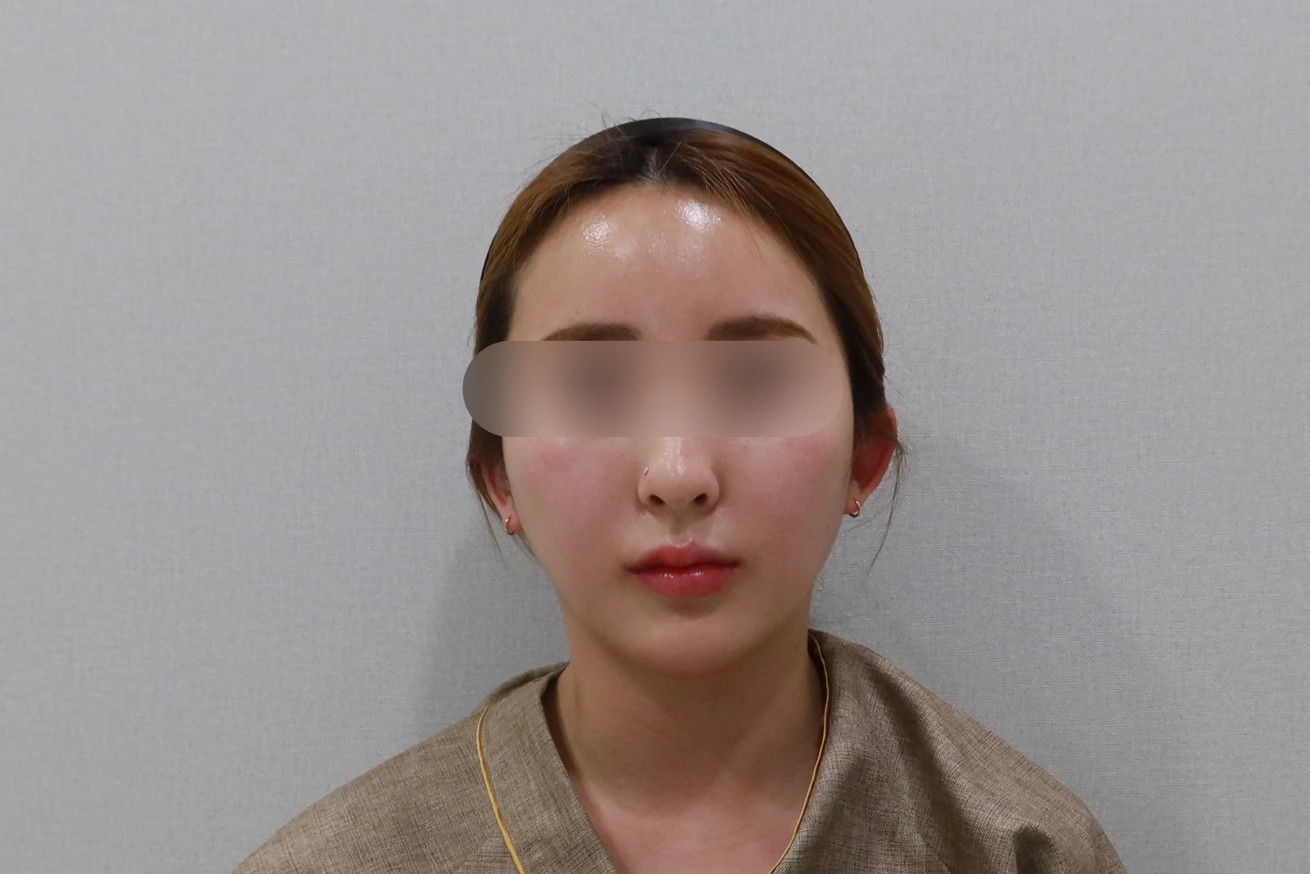 Frontal view before facial eraser injection 3