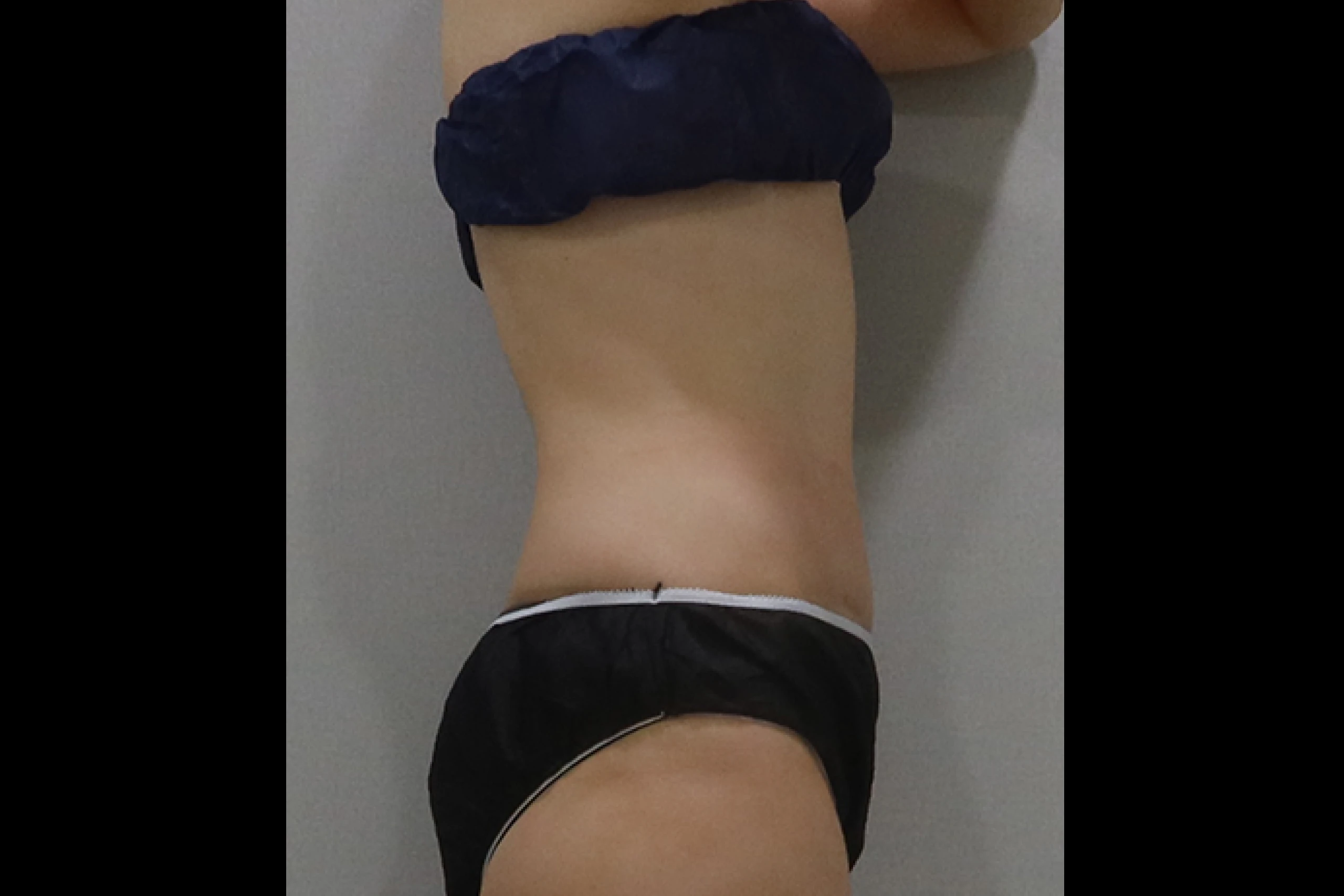 Side view after Premium TuneBody treatment 03