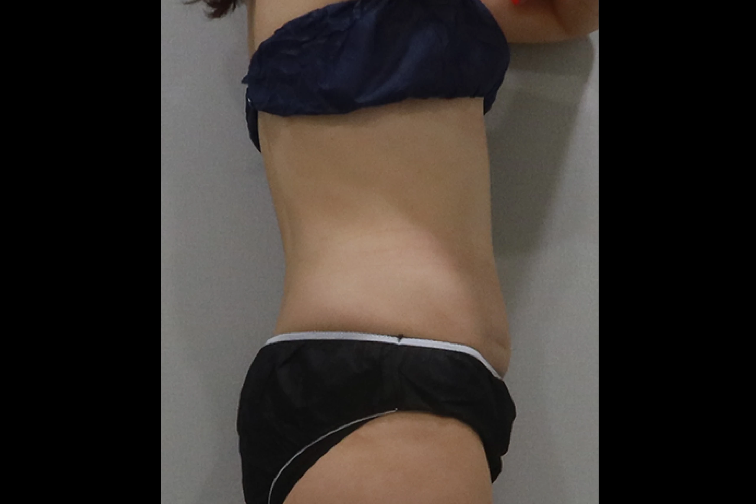 Side view before the Premium TuneBody procedure 03