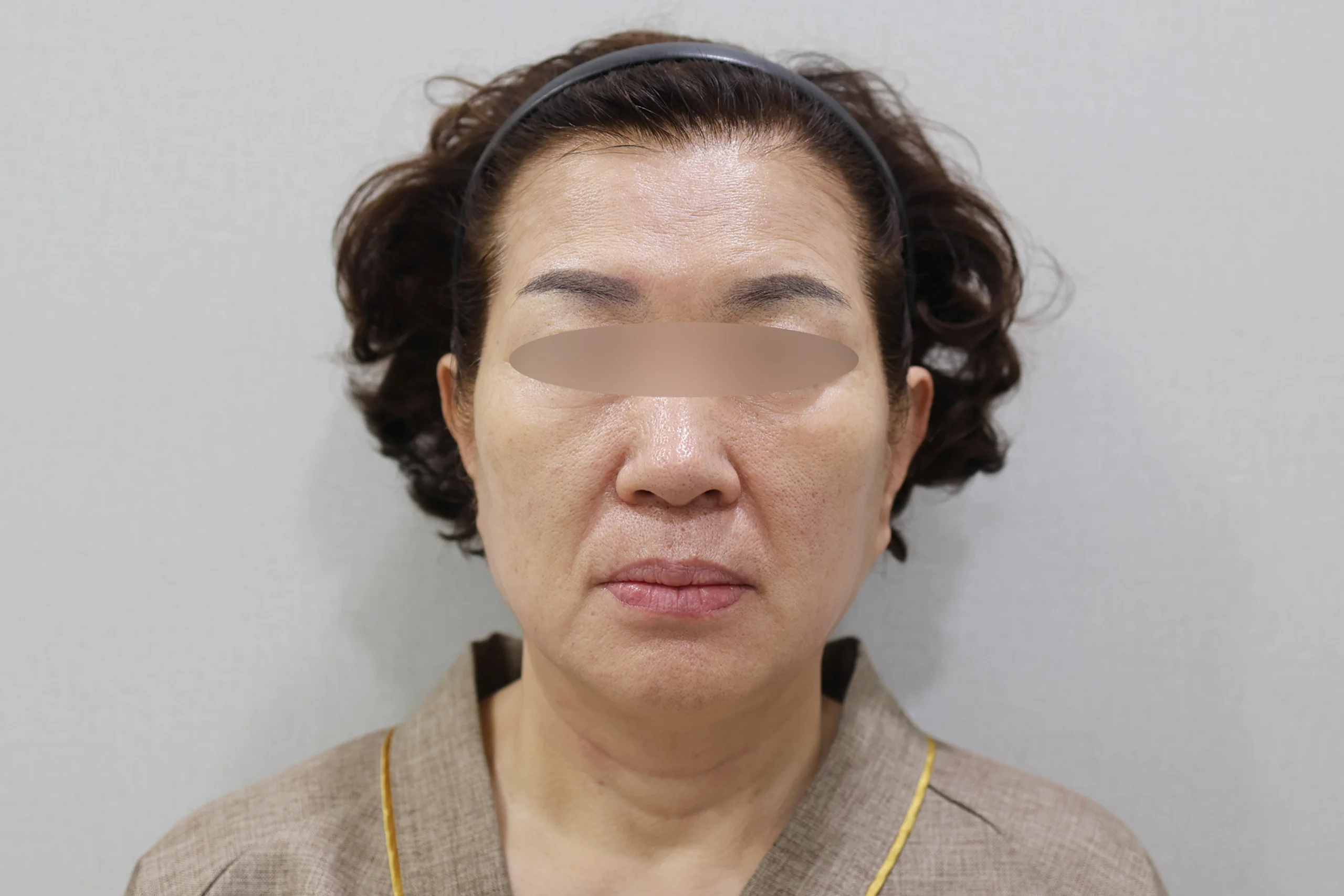 Frontal view 3 after XERF treatment