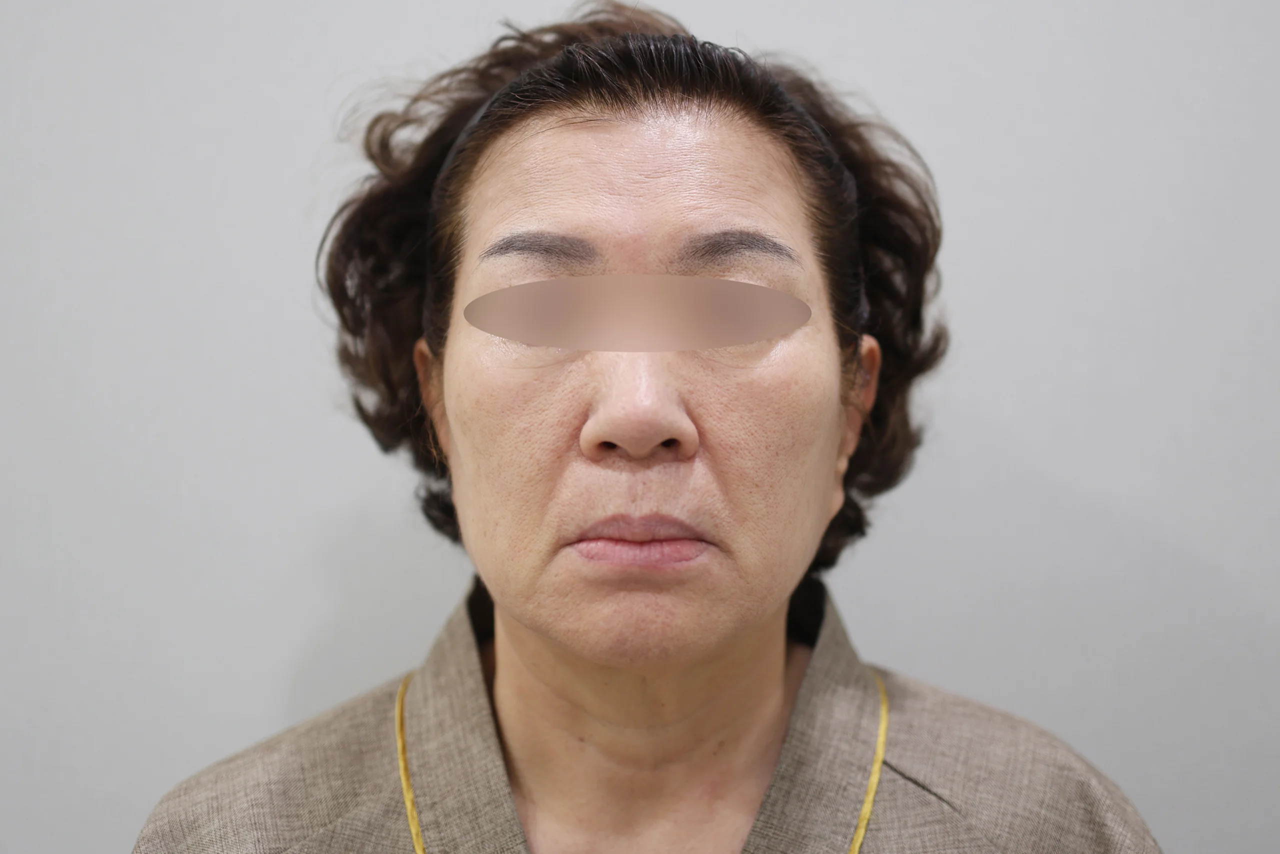 3 frontal photos before the XERF treatment