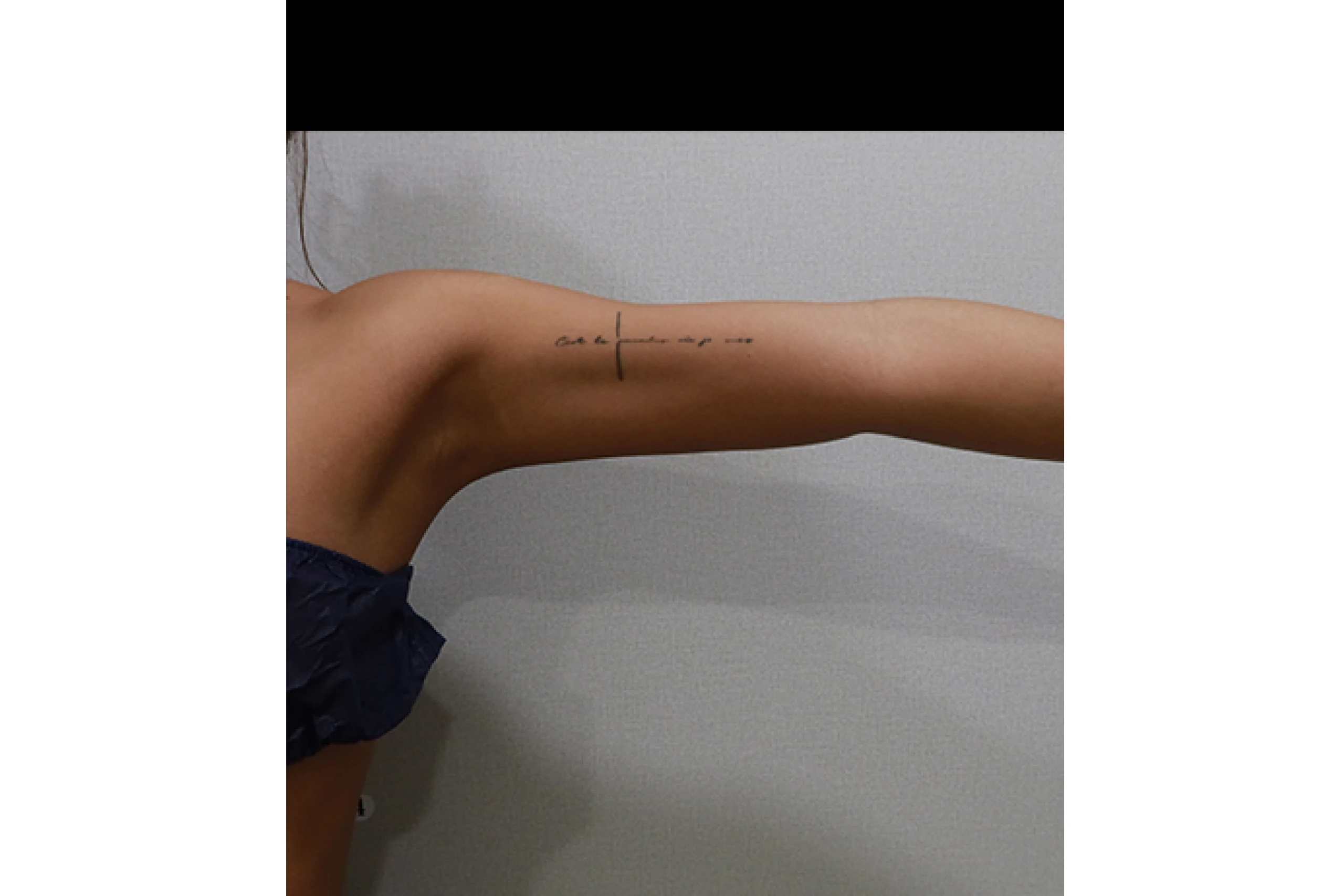 Side view after body titanium laser treatment 04