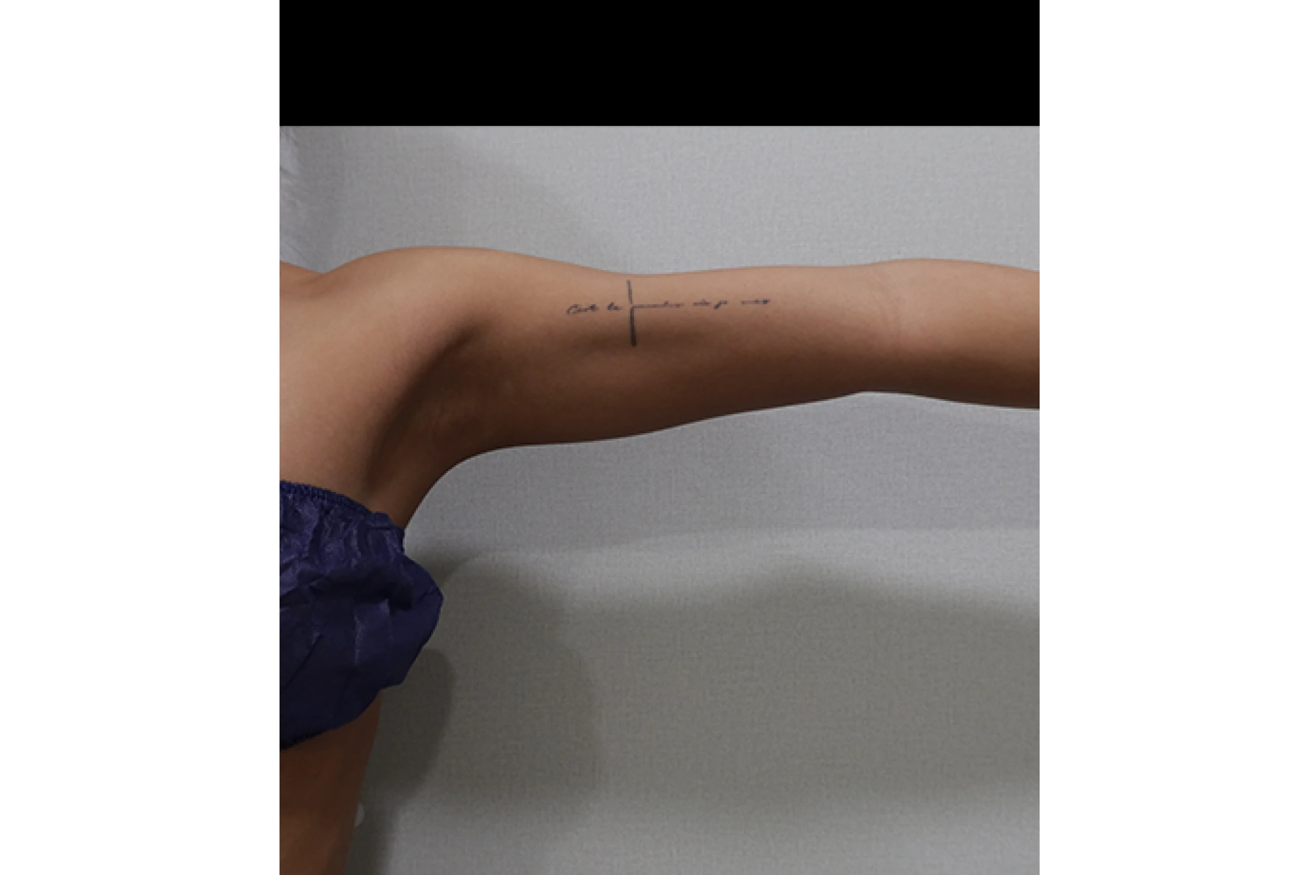 Side view before body titanium laser treatment 04