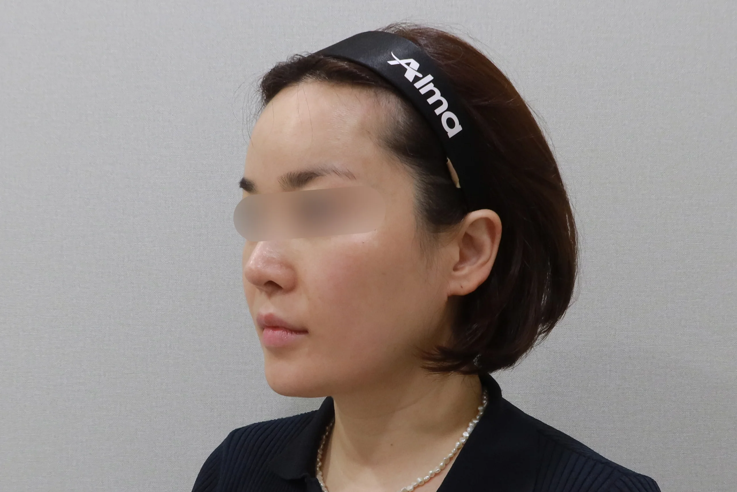 Side view after facial eraser injection 4