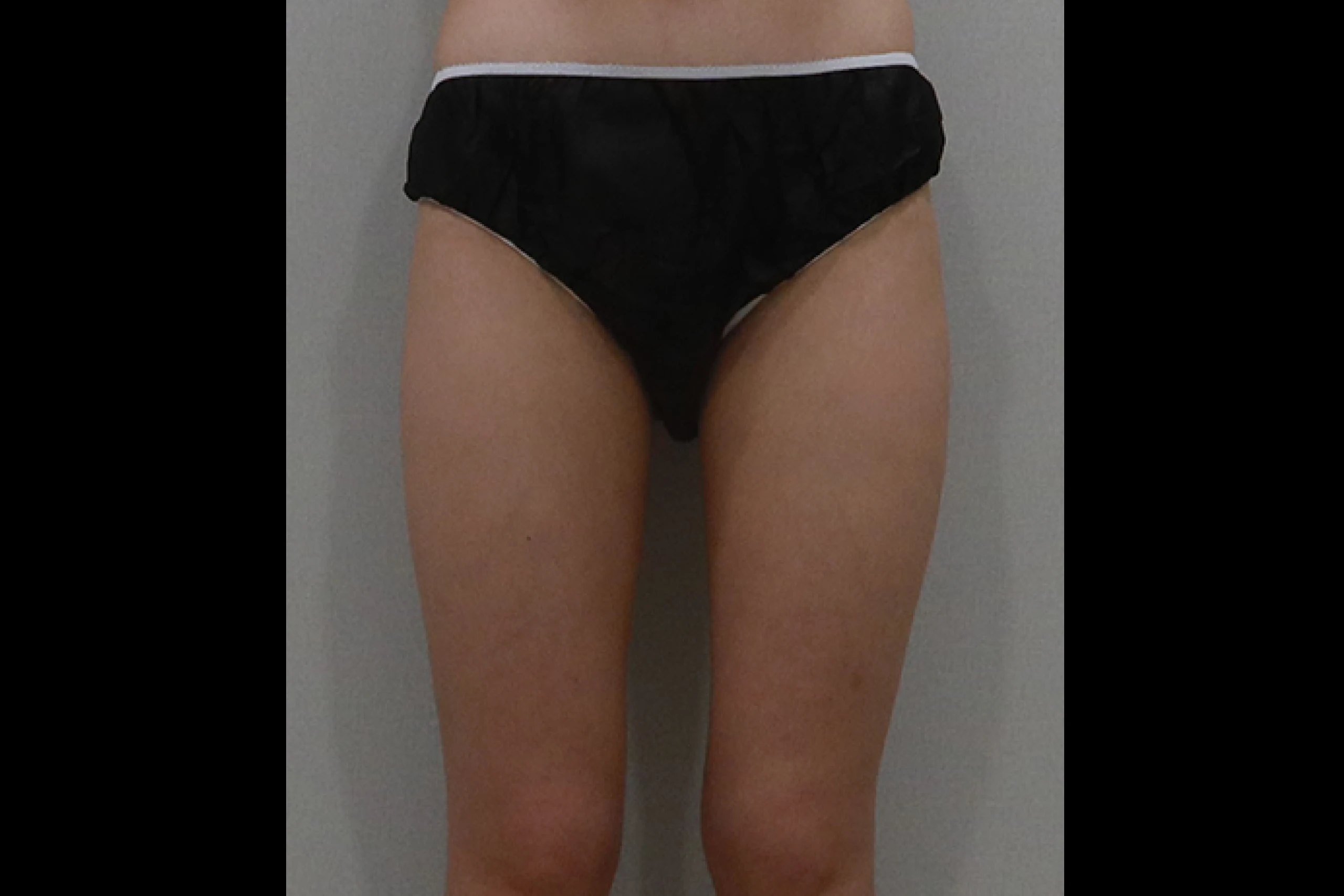 Frontal view before lower body fat reduction procedure
