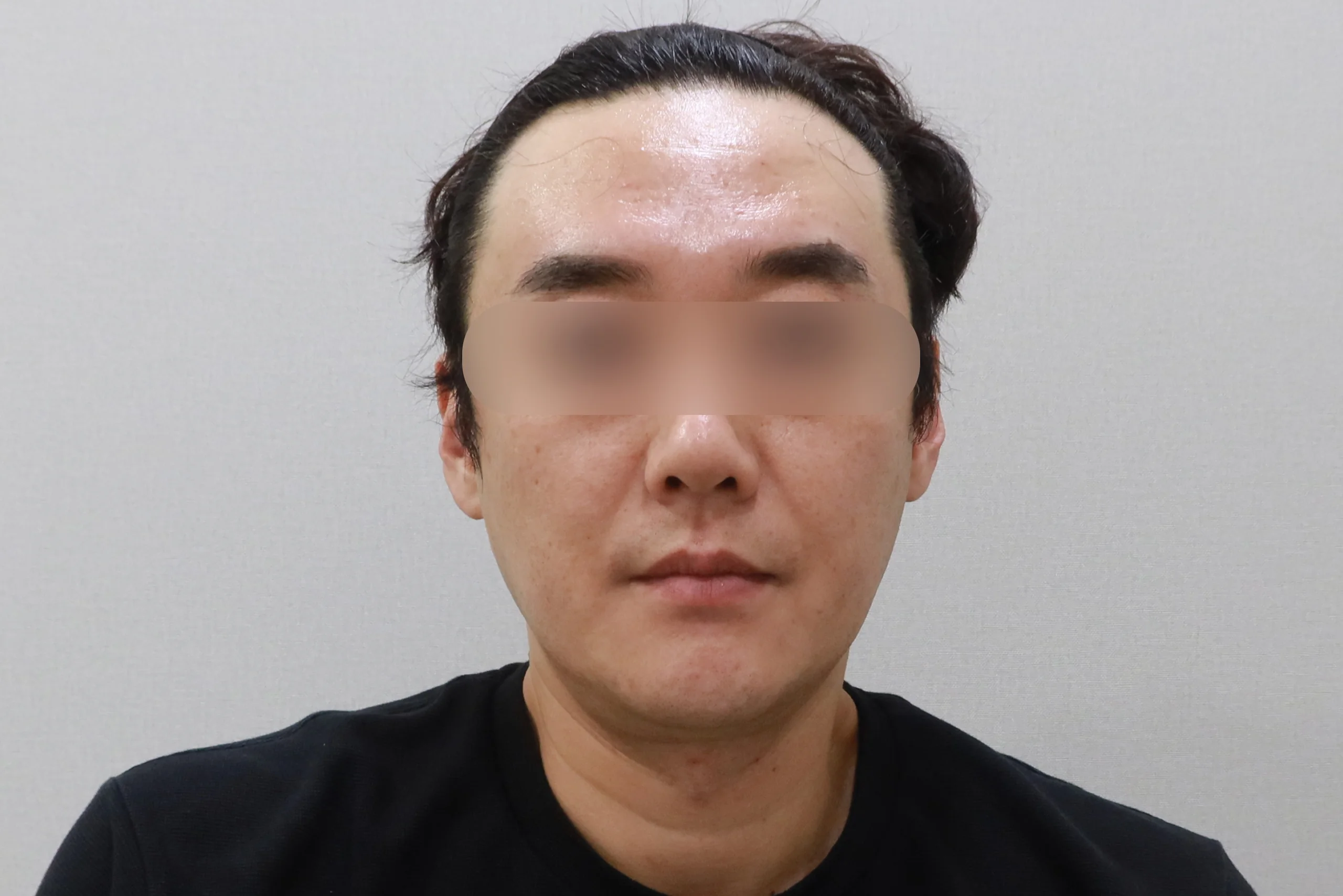 After the face eraser front