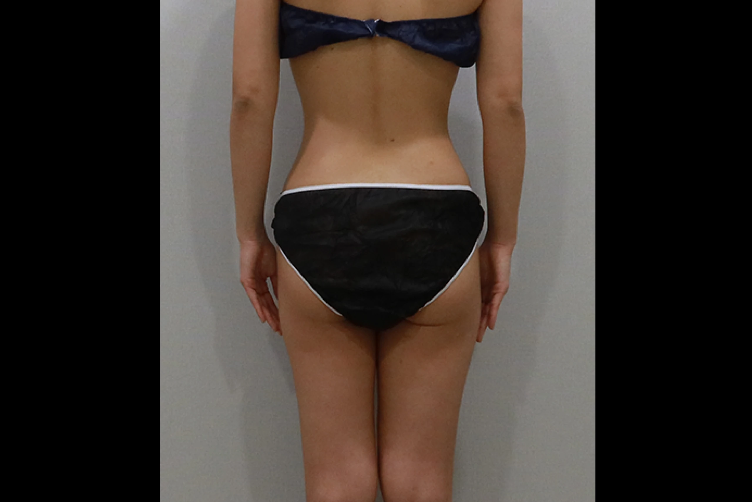 Frontal results after a full body fat reduction procedure