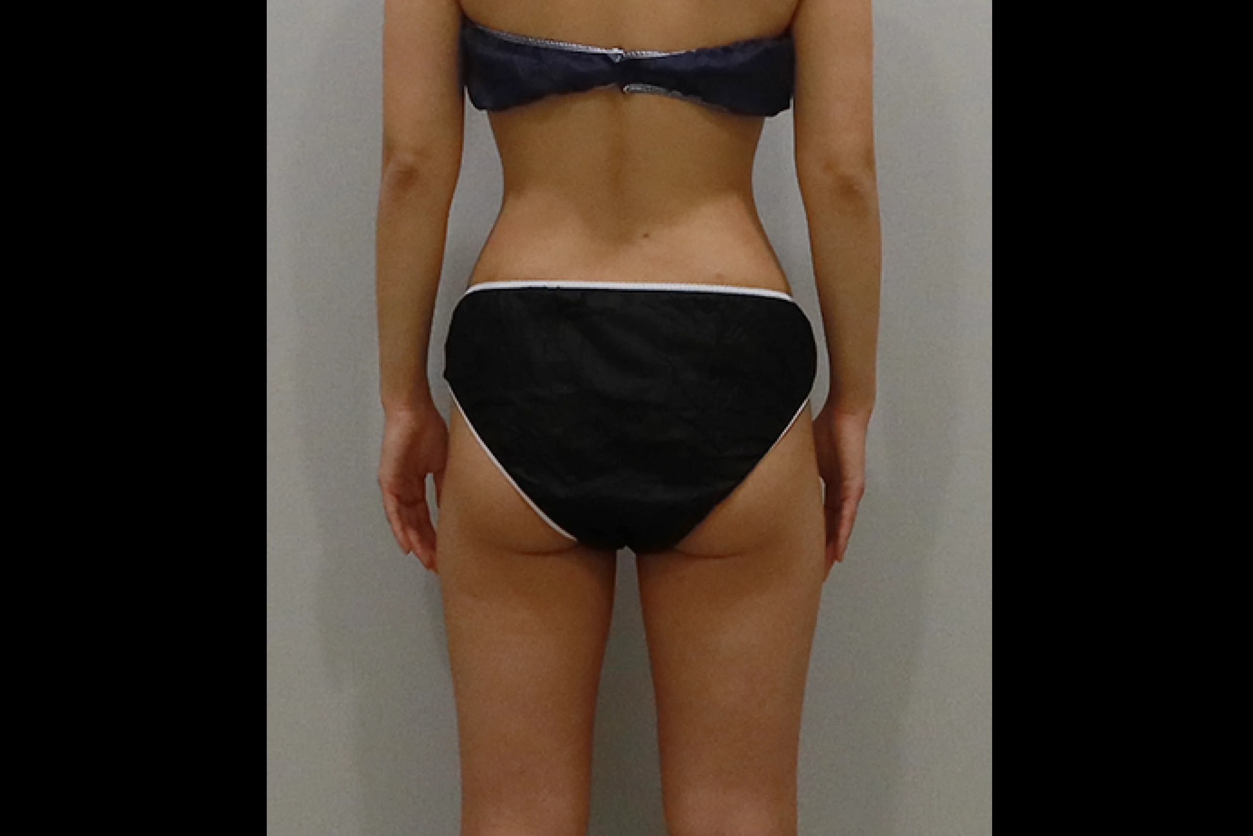 Frontal view before full body fat reduction procedure