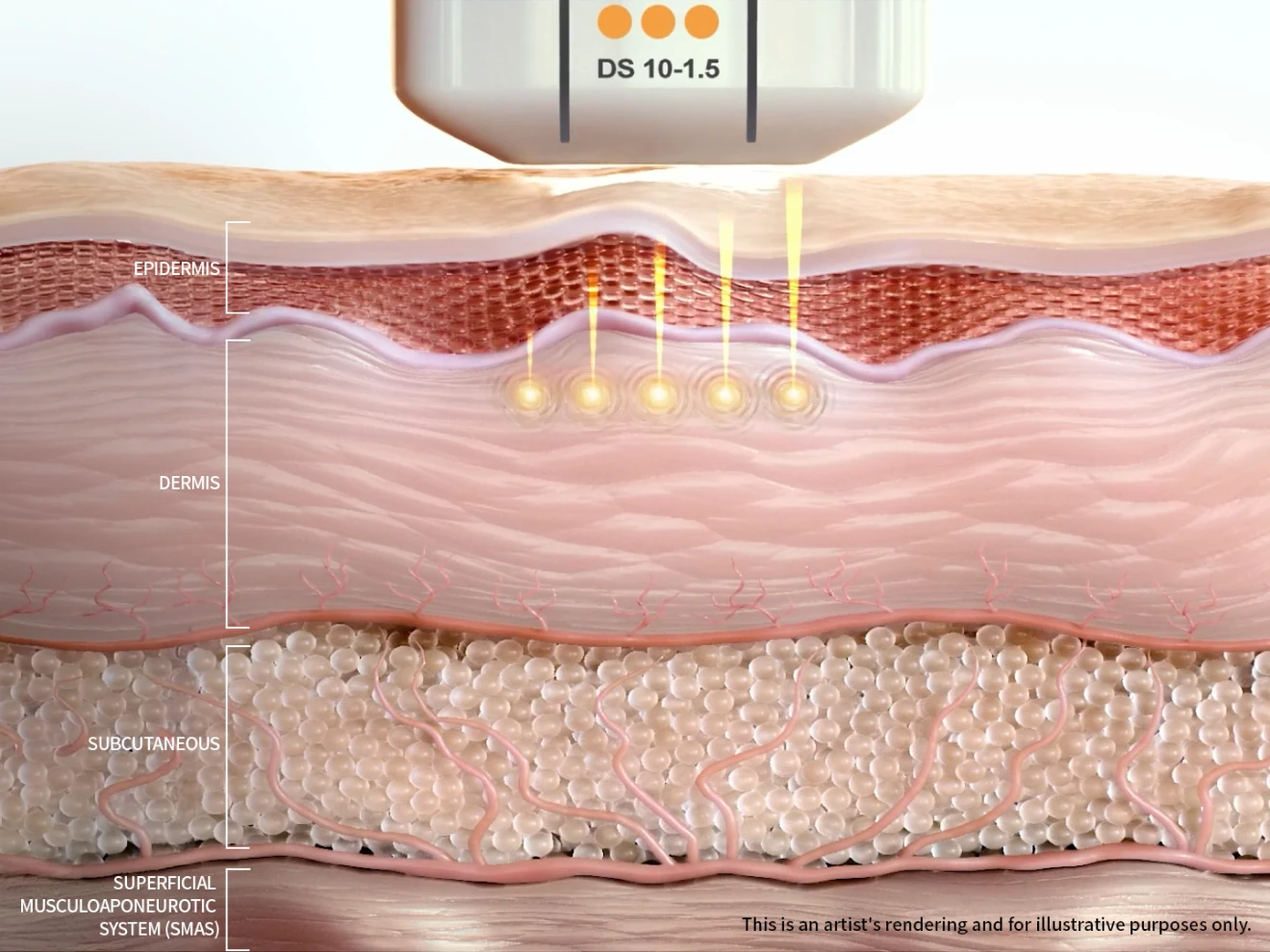 Ultherapy PRIME 1.5mm cartridge superficial dermis action cross-section