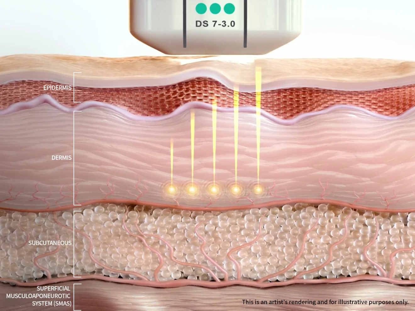 Ultherapy PRIME 3.0mm cartridge deep dermis action cross-section