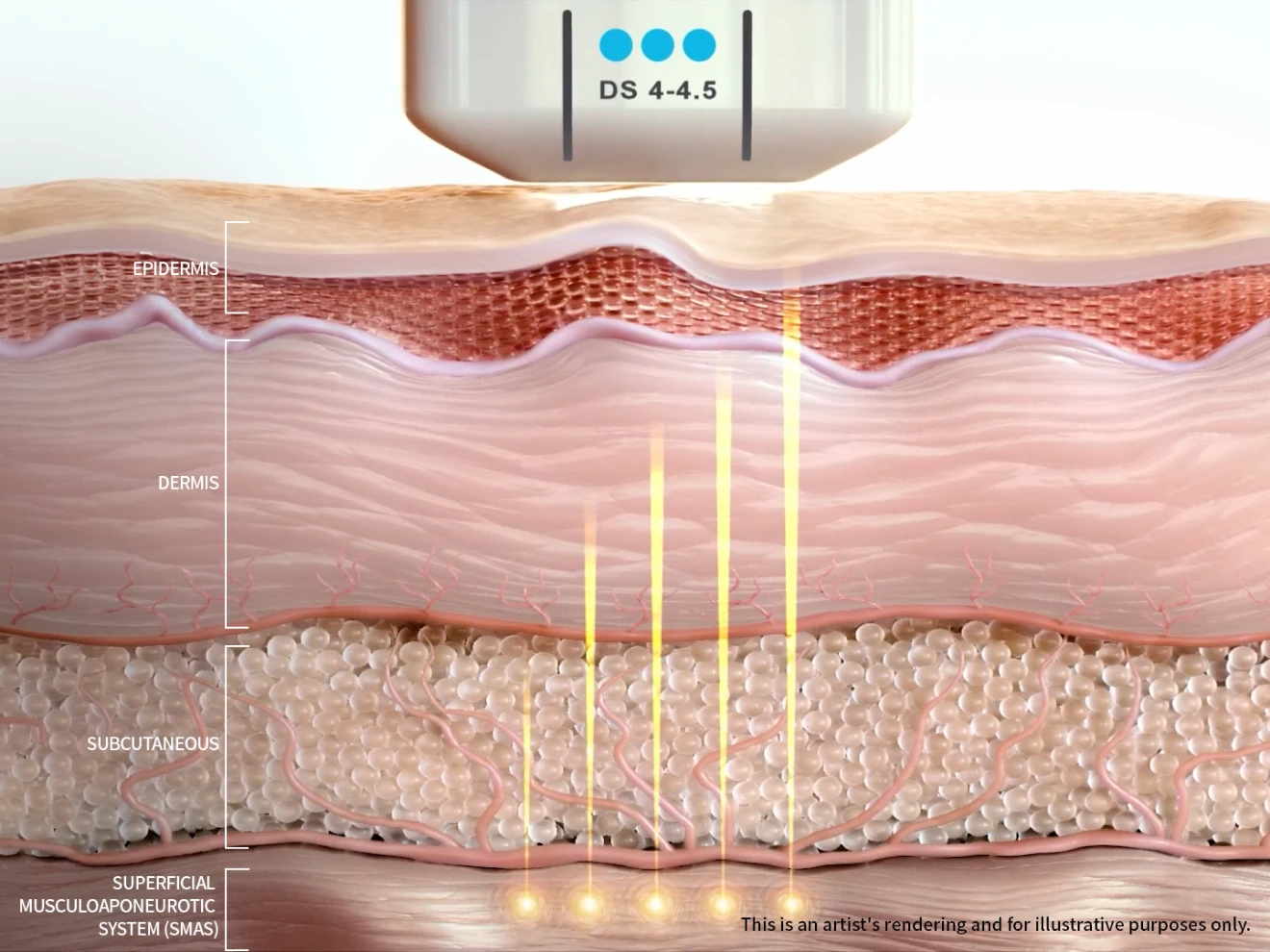 Ultherapy PRIME 4.5mm cartridge SMAS layer action cross-section